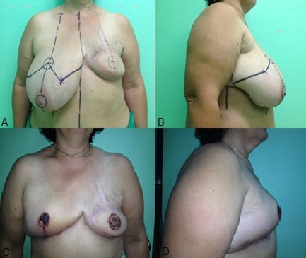 Figure 4: Oncological deformity of the breast. A: Preoperative - right gigantomastia with posoperative left asymmetry - front view. B: Preoperative - right lateral view. C: Posoperative at 21 days- frontal view. D: Posoperative at 21 days- right lateral view.