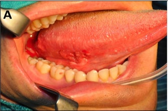 Figure 2: The schematic drawing demonstrates how without the preservation of the facial vein the dissected flap can rotate in any direction or twisted on its axis or passed inferiorly below the mandible to perform the required reconstruction.