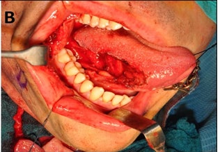 Figure 4: Intraoperative view of Balgi’s flap. It has an almost triangular shape anchored inferiorly by the underlying facial artery; all of the mucosa in circumferentially incised and no mucosal pedicle is present.