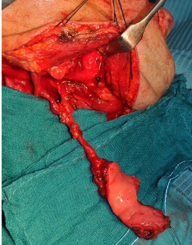 Figure 5: Final result with Balgi’s flap to reconstruct the tongue.