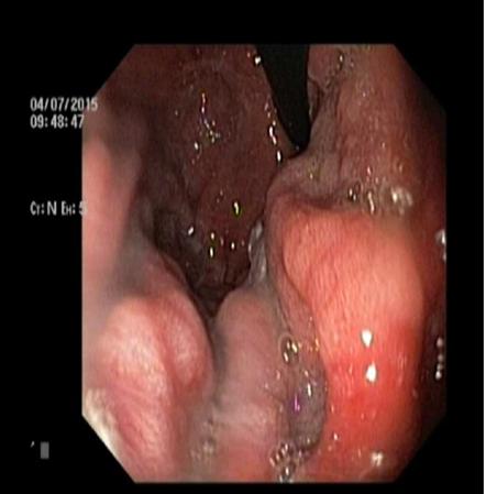 Figure 1: Endoscopic appearance of Giant gastric folds with overlying thick mucous.