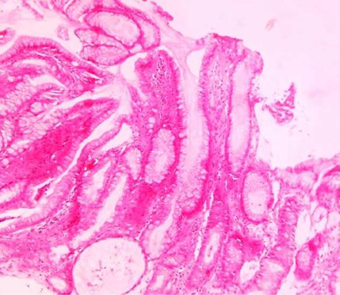 Figure 3: Histopathology showing Foveolar hyperplasia.
