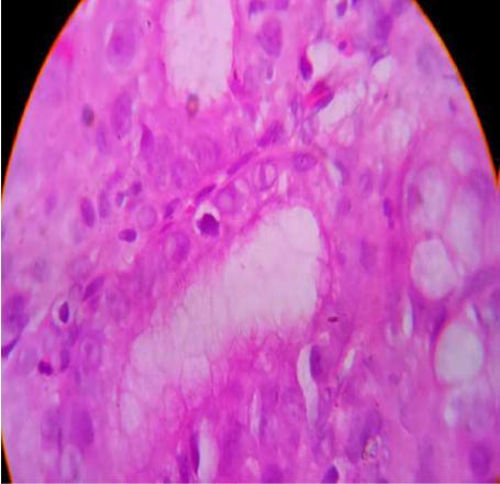 Figure 4: Histopathology showing cytoplasmic inclusion bodies.