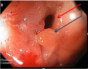 Figure 1: CT sinogram showing thickening of anterior abdominal wall with loops adherent to the abdominal wall and contrast lined tract extending from terminal ileal loop to the skin (Red arrow) suggestive of enterocutaneous fistula.