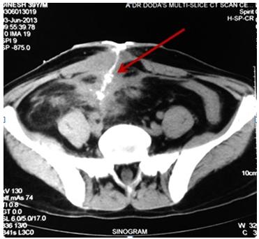 Figure 2: Pre-operative Colonoscopic picture showing multiple nodules in the caecal area (Blue arrow) with narrowing of illeocecal junction (Red arrow).