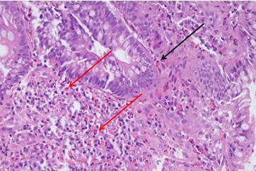 Figure 5: Surveillance colonoscopy after illeotransverse anastomosis and chemotherapy showing superficial ulcers (Black arrow) at the anastomotic site.