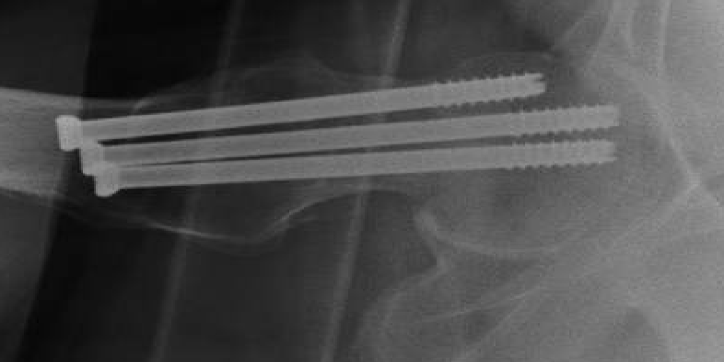 Figure 1: (a) AP and (b) lateral radiographs show placement of cannulated screw prior to fractures. (c) AP radiographs demonstrates post-operative subtrochanteric fracture that occurred 5 years later.