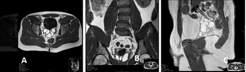 Figure 2: (a) T1 w TSE axial(a), coronal (b) and sagittal (c) showing cystic changes of the seminal vesicle and dilated ejaculatory duct on the right side (arrow).