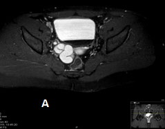Figure 4: T1 w axial with Fat-suppression and Contrast showing cystic changes of the seminal vesicle without any enhancement.