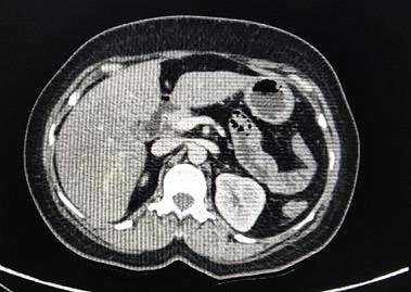 Figure 1: Axial contrast enhanced computed tomography image shows normal size pancreatic head and bowel loops in pancreatic bed anterior to splenic vein described as dependent intestine sign.