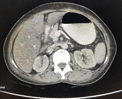 Figure 2: Axial contrast enhanced computed tomography image shows normal size pancreatic head and pancreatic bed anterior to splenic vein is filled by stomach described as dependent stomach sign.