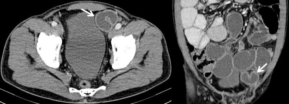 Figure 3: Contrast-enhanced CT of the abdomen revealing dilation of several small bowel loops with a transitional area in “closed-loop” in the left paravesical space, displacing the left anterolateral wall of the bladder, findings suggestive of a left paravesical hernia.