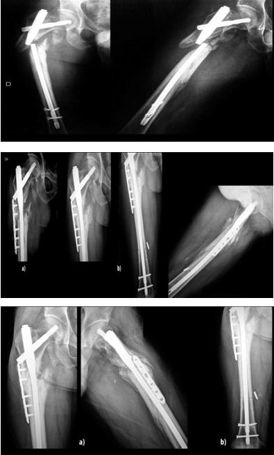 Figure 1: X-Ray showed a proximal femur atrophic non- union with the intramedullary PFNA (Synthes, USA) nail broken at the level of the fracture site with an atrophic ascended fragment.