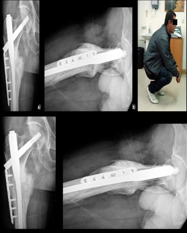 Figure 4: X ray appearance at 7 months, there already appears a bridging callus on the medial cortex and a complete bone healing in the lateral, anterior and posterior cortices. Figure 4b: Broken proximal locking bolt.