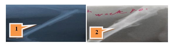 Figure 3: 1). • The pin can be removed from the fracture femoral bone after the radiological union at the end of the six week with clear signs of the hard callus formation and disappears of the fracture line (Figure 3.2). • Type of fracture healing by secondary bone repair by endochondral ossification .with new hard callus formation continued by remodeling phase • **Disadvantages:** • Excessive amount of the new bone formation around the fracture site • Multiple bone fractures especially at the distal fragment or a site of fracture (Figure 4.1 and 4.2). • The FGSR penetrate distally to the stifle joint (Figure 4.3.) • The pin may not insert in the distal fragments or it may be out (Figure 4.4). • None or mal union may be occurs during healing fractures processing. • The FGSR fill bony canal and interfere with bone marrow and circulation.