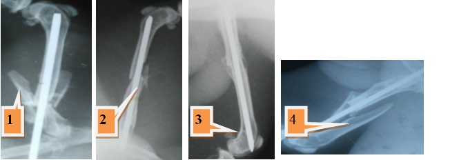 Figure 4: The disadvantages of using FGSR, 1. Multible fractures in the proximal fragment of femoral bone, 2. Chip fracture around the fracture site, 3. The FGSR penetrate the distal end of the femoral bone in the stifle joint, 4. The FGSR not insert properly in the distal fragment of the femoral bone.