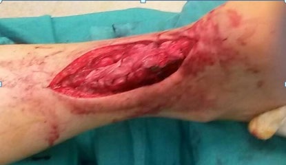 Figure 2: Achilles tendon ruptures mr Image.