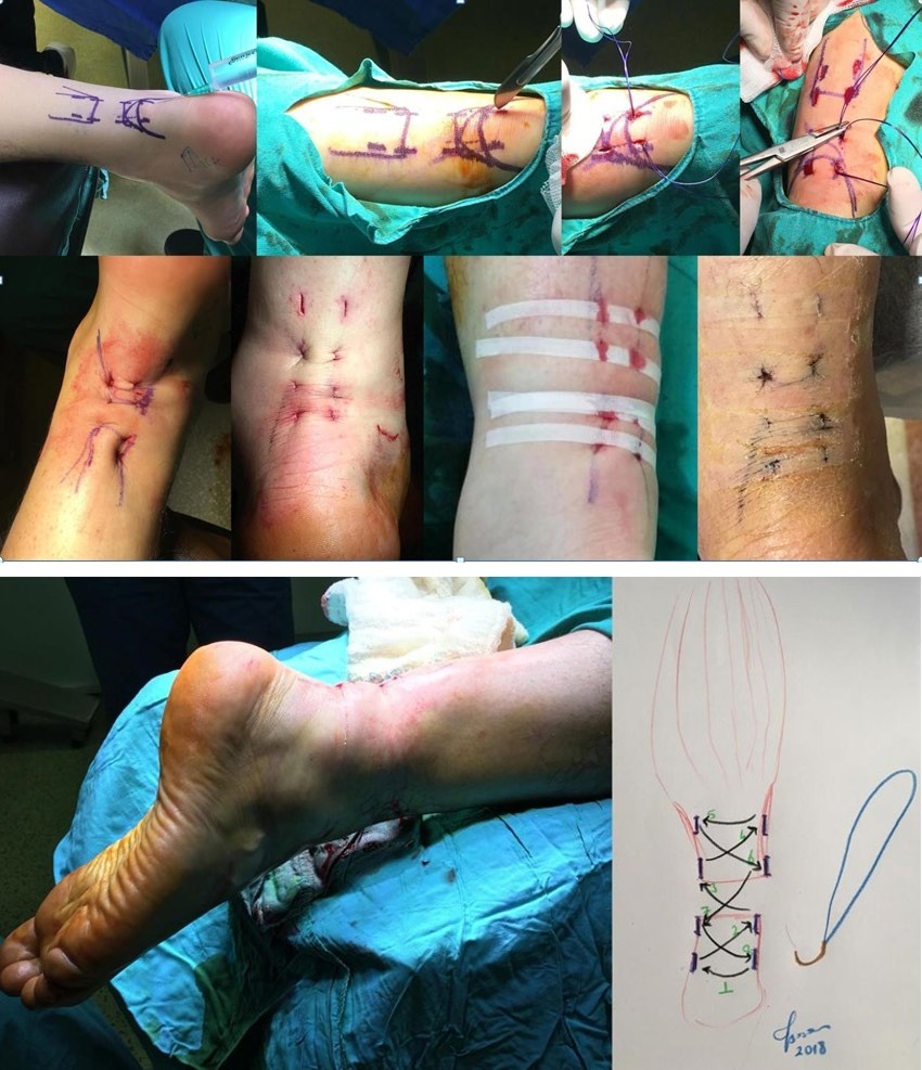 Figure 4: Percutaneous Achilles tendon rupture repair.