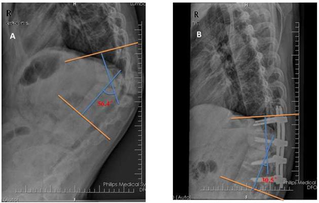 Figure 1: The Cobb angle was 56.4 degree before the operation(A). The Cobb angle drastically decreased to 30.5 degree after surgery (B) .