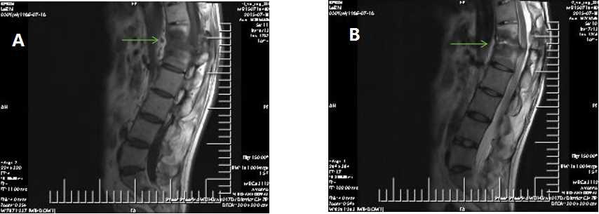 Figure 3: T1-weighted(A)and T2-weighted (B) sagittal MRI images reveal destructive structures. The lesion has resulted in a severely narrowed spinal canal with dural compression.