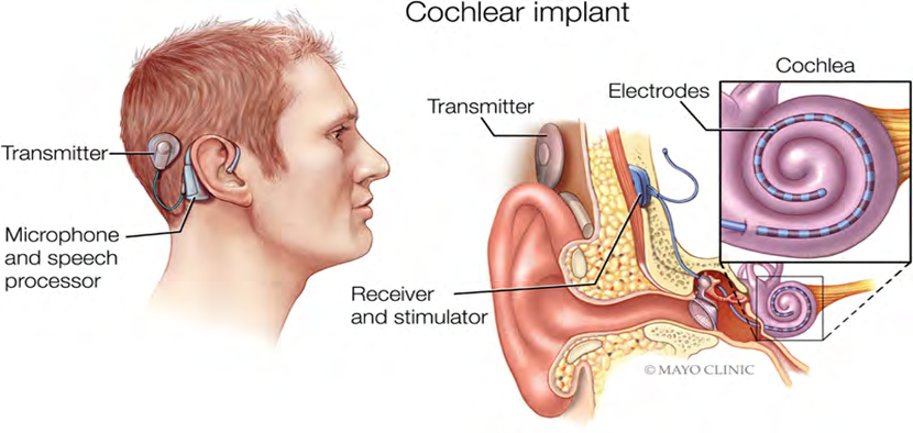 Figure 1: Component of Cochlear implant system.