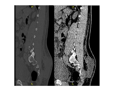 Figure 1: XR Lumbar Spine: Alignment is maintained with some straightening of the normal lumbar lordotic curvature which may be due to muscle spasm.