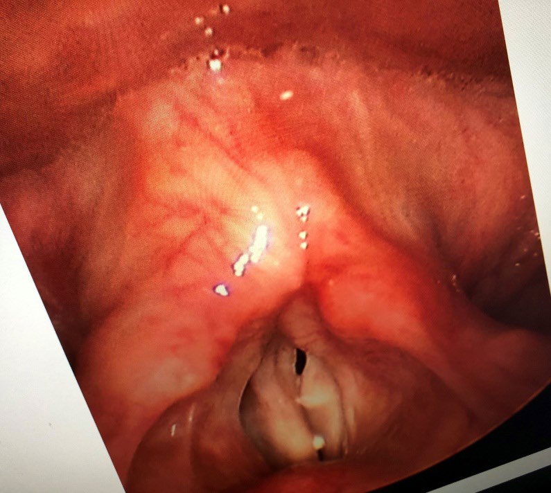 Figure 1: Bilateral vocal cord paralysis.