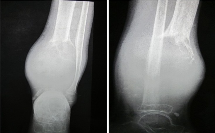 Figure 2: Radiograph of the left both bone leg with ankle AP and Lateral view showing expansive lytic lesion in metaphysio-diaphyseal region, periosteal reaction and cortical breach with soft tissue involvement.