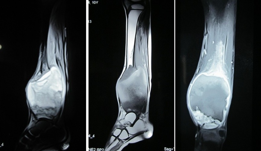Figure 3: T1WI and T2WI MRI axial section showing mixed heterogenous with fluid filled spaces cystic composition of lesion, Hyperintensity caused by cystic lesion is better appreciated on T2WI.