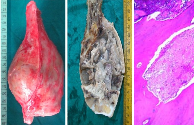 Figure 4: Gross appearance of the tumour, cut section and histopathology.