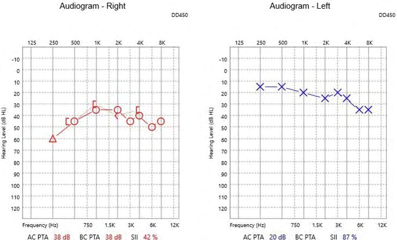 Figure 1: Audiogram of patient tested February 2018.