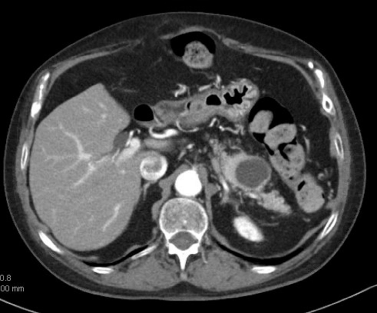Figure 1: CT scan abdomen demonstrating a cystic lesion in the tail of the pancreas.