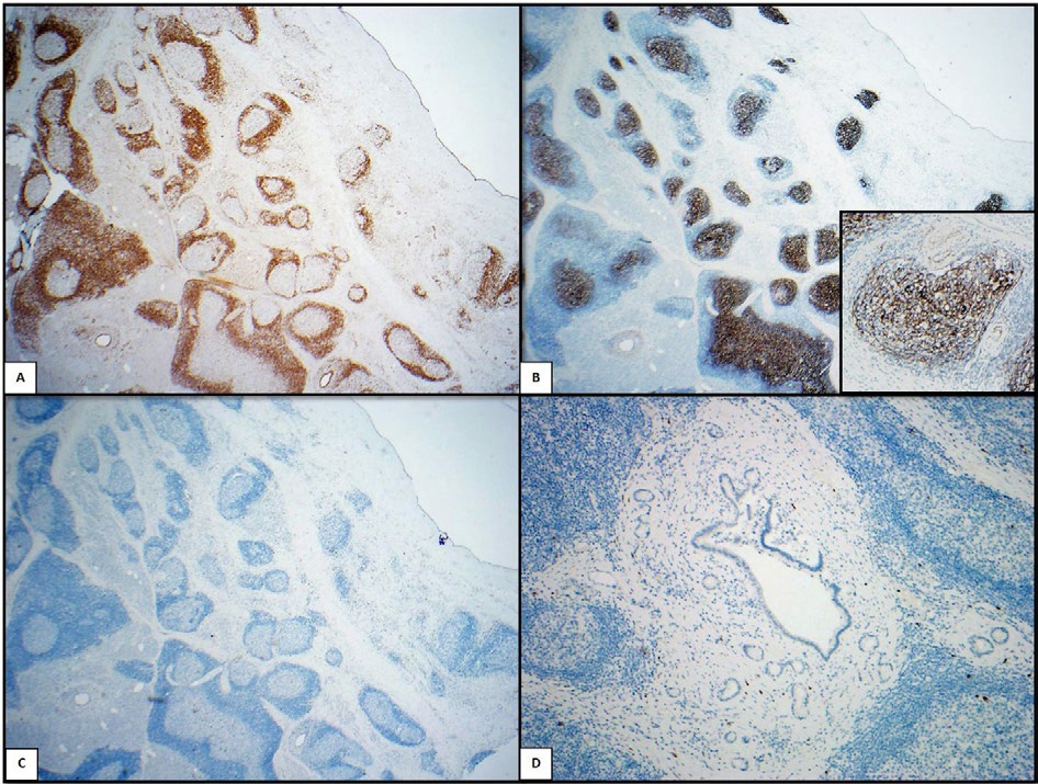 Figure 4: Bcl-2 immunohistochemical stain is negative germinal centers (A), CD21 highlights intact follicular dendritic network (B). IgG4, low and high magnification, shows low number of IgG4+ plasma cells (C & D respectively).