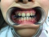 Figure 4: Adjustment of the aparatology in the mouth with articular paper.