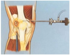 Figure 3: Lateral release with Yerys technique [2].