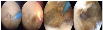 Figure 5: LRL was released with electrocautery.