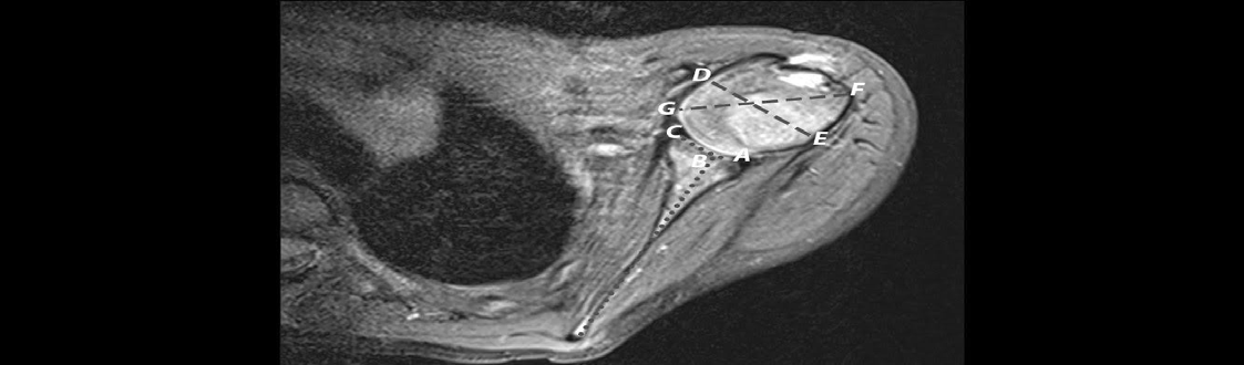 Figure 1: A) Preoperative period, 1-year-old-female patient B) Postoperative period, after 34 months follow-up. In follow- up, preoperative GV and EI value measurement in MRI axial sections with T2 sequences of a case in our clinic. In follow-up, increase in GV and decrease in EI draw attention.