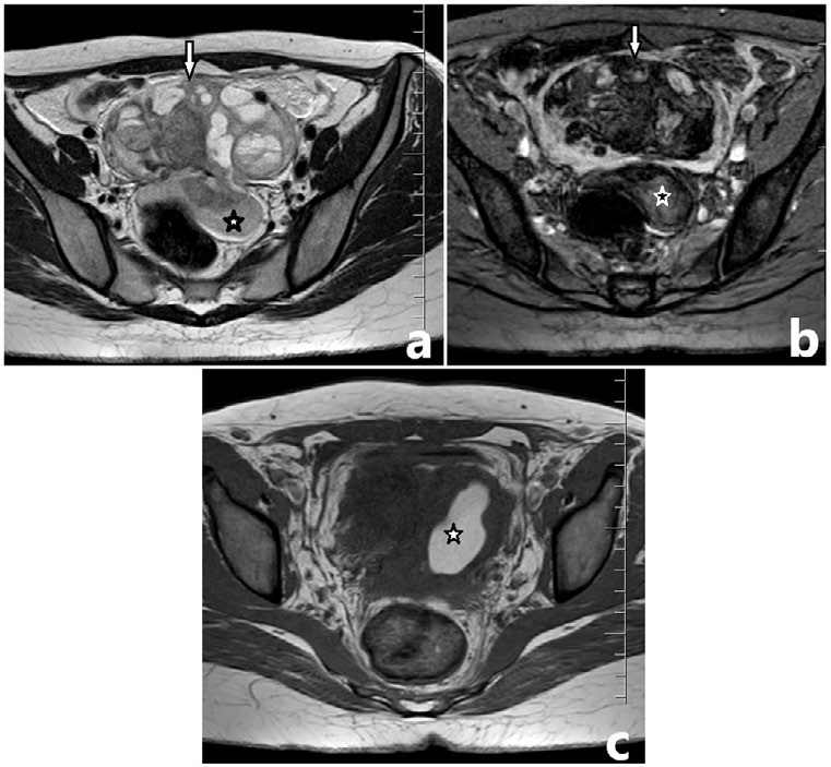 Figure 1: MRI abdomen / Pelvis showed complex cystic.