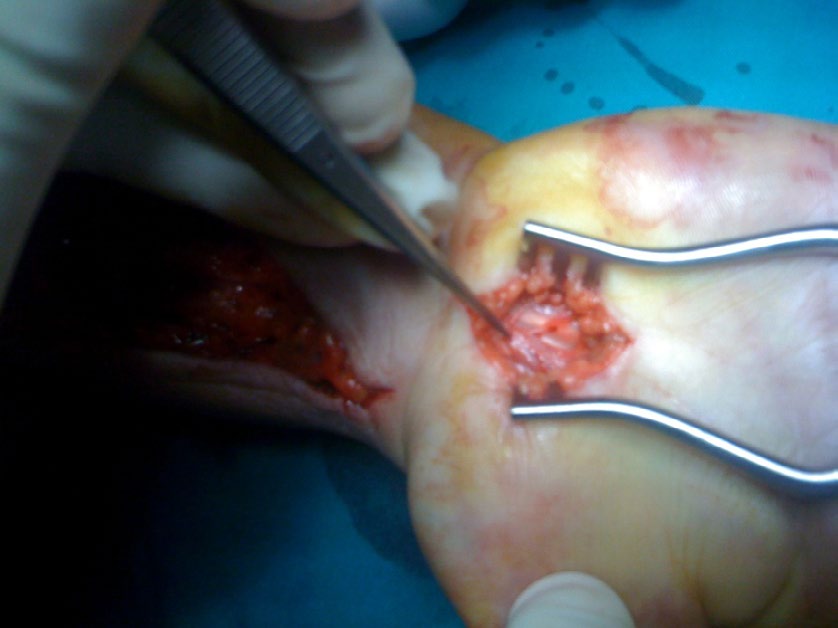 Figure 5: Excision of the lesion en block.