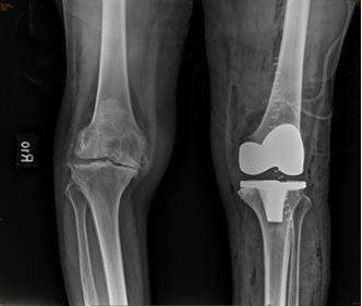 Figure 4: Lt TKA correction of varus to 6 degree Valgus but LLD noted.