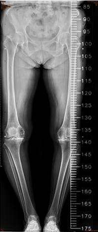 Figure 6: Post-Op Standing View.