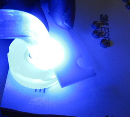Figure 3: Excess resin cement (half-moon) cement light cured for a defined time with a standard distance of 2mm.