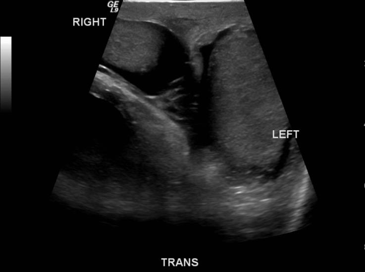 Figure 2: After his imaging was reviewed, a foley catheter was placed with return of 2 liters of urine. He re- examined following foley catheter placement and his scrotum had decreased in size. Additionally, he was noted to have increased urine output in foley when direct pressure was applied to scrotum. ACT scan was the performed which revealed a large sliding inguinal hernia 8with 90% of the bladder and bilateral ureters herniating into the scrotum (Figure 3).