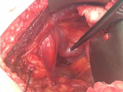 Figure 4: After the hernia was reduced, a cystoscopy was performed revealed dark necrotic patches at the dome of the bladder. Given these findings, a partial cystectomy was performed. An open Lichtenstein herniorrhaphy was then performed. The patient was discharged the following day in excellent condition