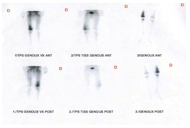 Figure 4: Three-phase bone scintigraphy showing an asymmetry of perfusion and uptake of radiotracer opposite the two knees more marked on the right side during the flow phase, the blood pool and the delayed phase evoquing an osteoarthritis of the right knee.