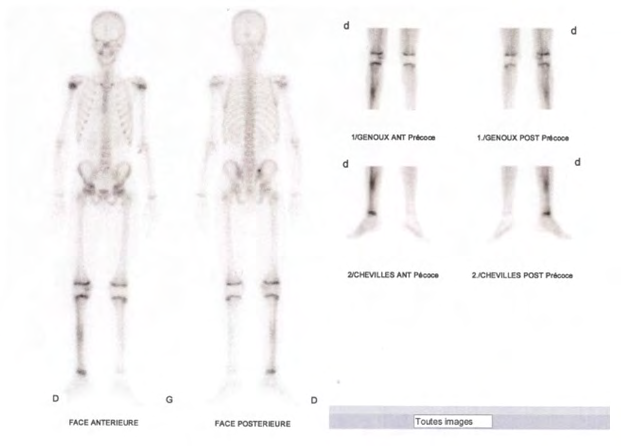 Figure 5: Three-phase bone scintigraphy showing an asymmetry of perfusion and uptake of radiotracer opposite the two tibial diaphyses more marked on the right side during the flow phase, the blood pool and the delayed phase evoquing an osteomyelitis of the right tibia.