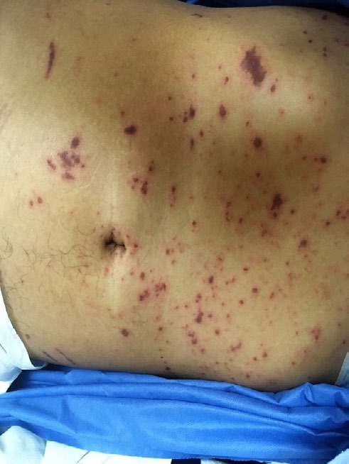 Figure 1: Crusted lesions on the abdomen.