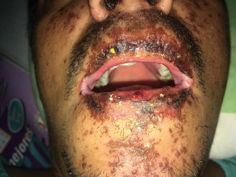 Figure 2: Patient with multiple lesions on the lips and face.