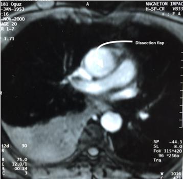 Figure 2: CABG on OM1 and Mitral Valve Replacement.