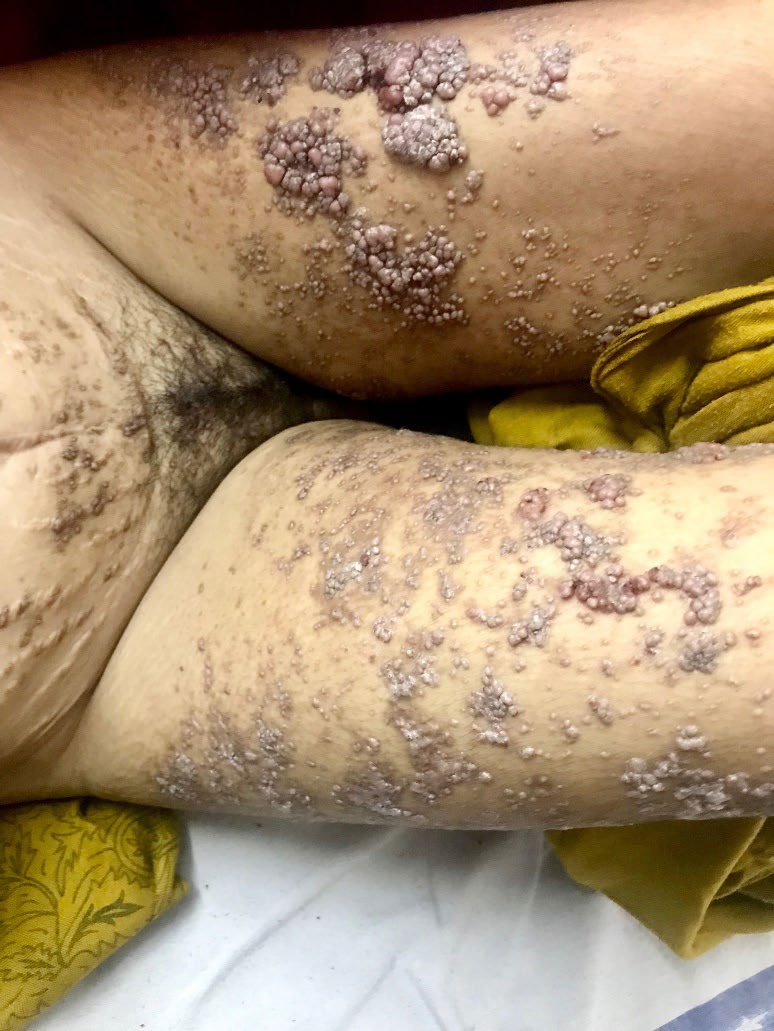 Figure 1: Exuberant violaceous papulomatous plaques present bilaterally on legs.